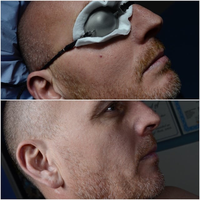 Campbell de Morgan spot removed from cheek