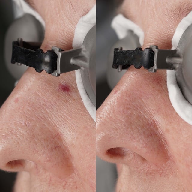 Spider angioma to nose treated at Highland Laser Clinic