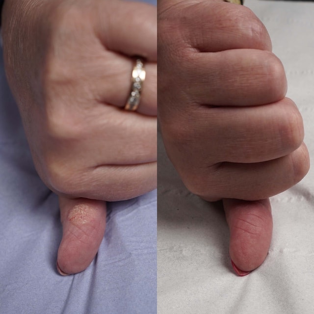 Close-up of thumb wart successfully removed with two sessions of laser treatment