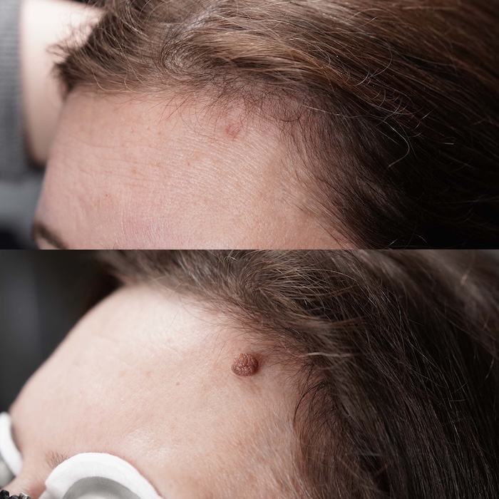 Before and after laser skin tag removal from the forehead, showing clear skin after treatment
