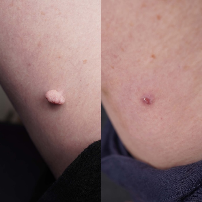 Large skin tag on upper thigh successfully removed with laser over two sessions.