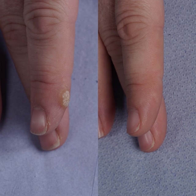 Large finger wart cleared after one laser treatment using long-pulse Nd:YAG