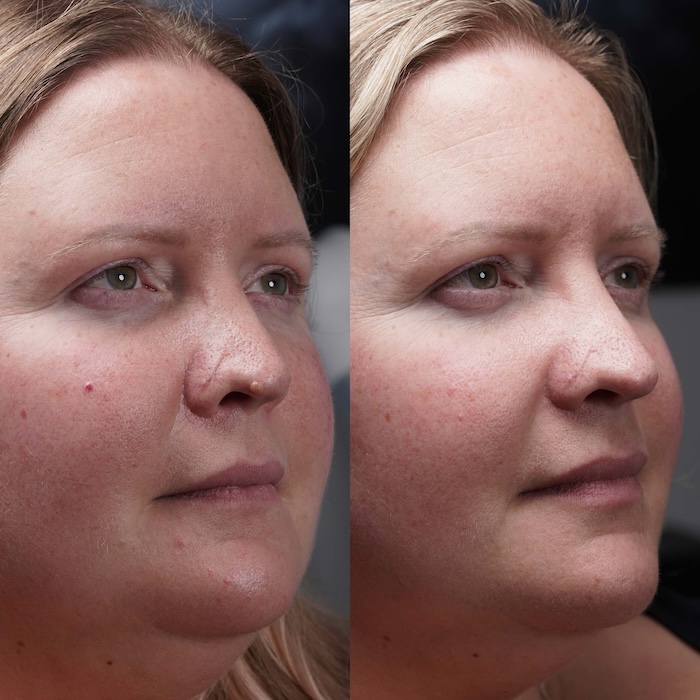 Before and after of woman with fibrous papule of the nose removed + removal of angiofibroma