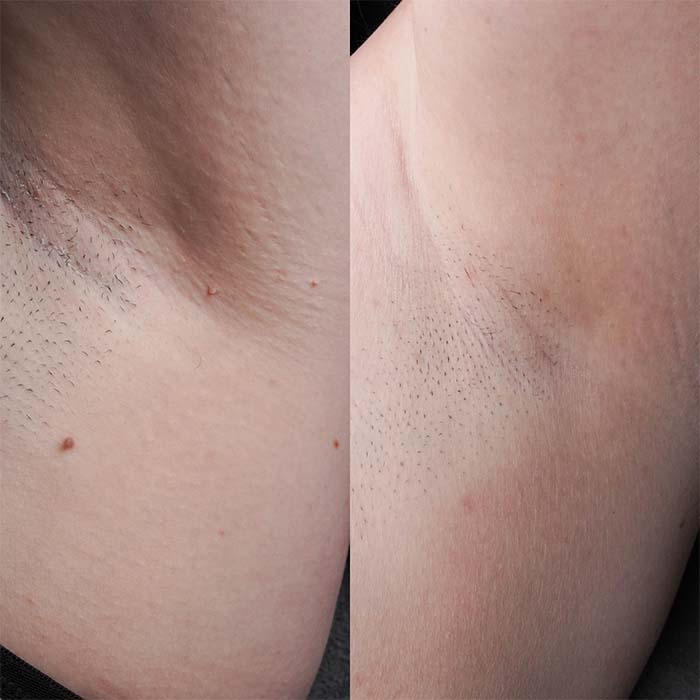 Underarm skin tags gone in one treatment