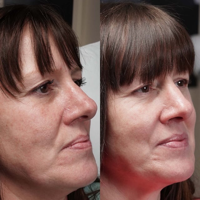 Telangiectasia removed from nose and cheeks for a clear complexion