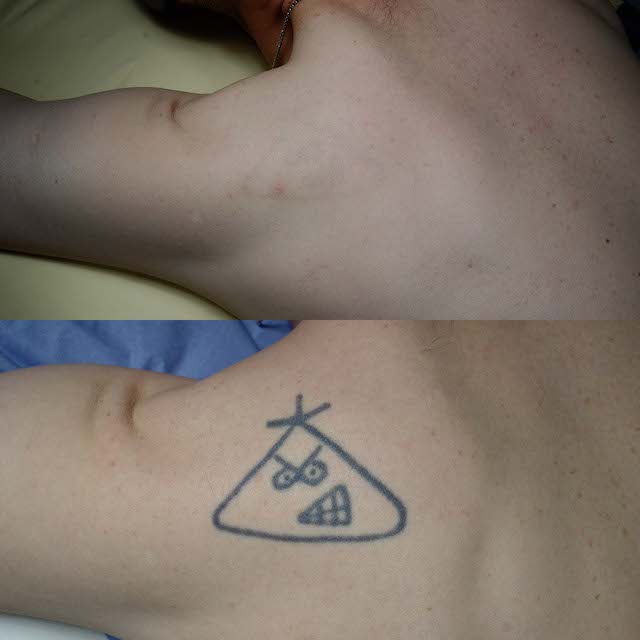 Tattoo removal before and after