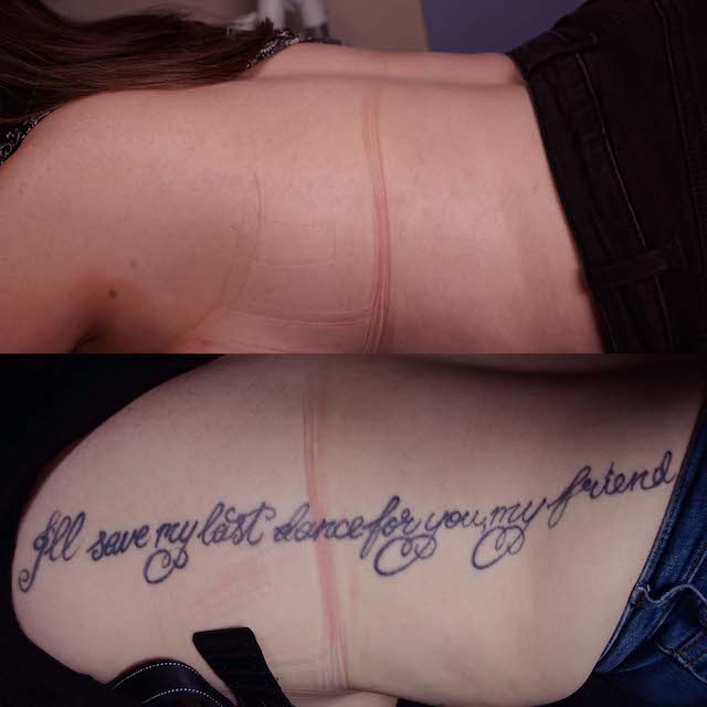 Tattoo removal before and after
