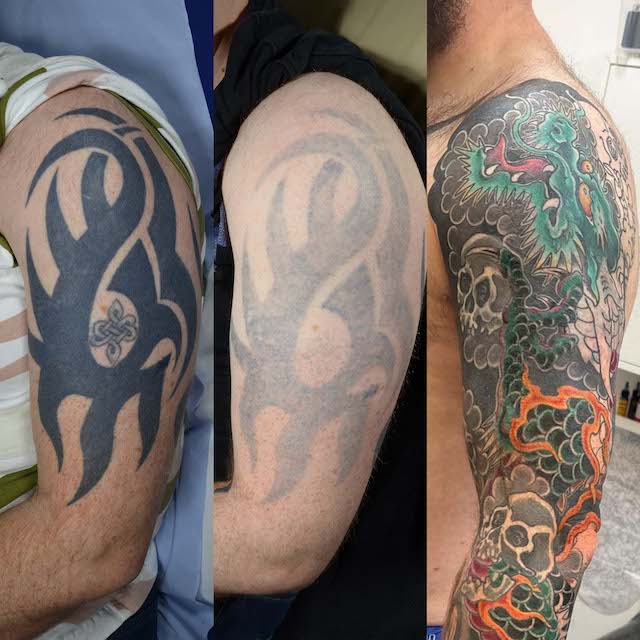 Tattoo removal coverup before and after
