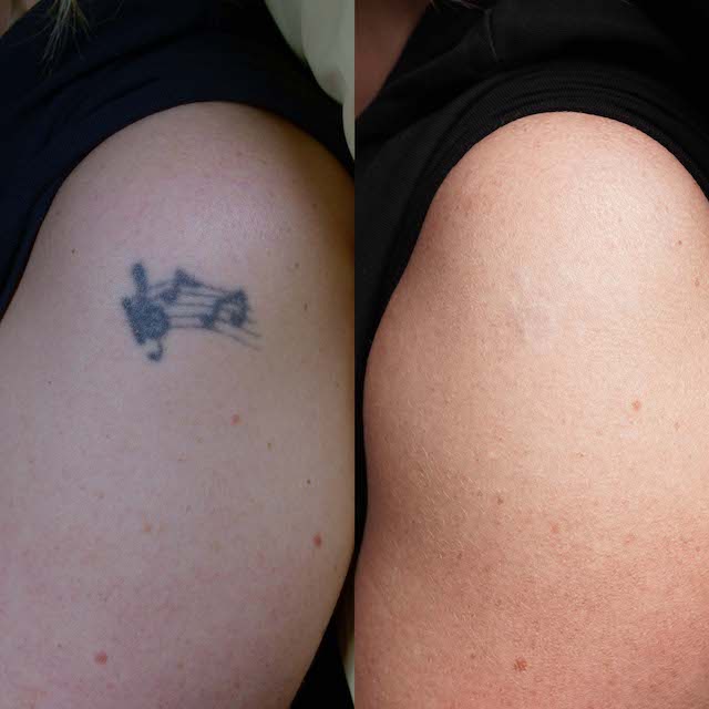 tattoo removal before and after