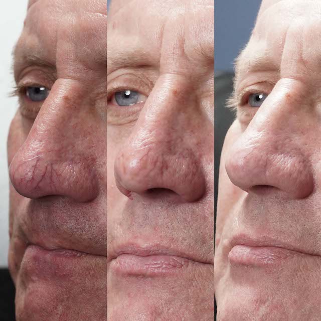 Vein removal before and after