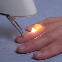 Laser verruca and wart removal with pinpoint accuracy